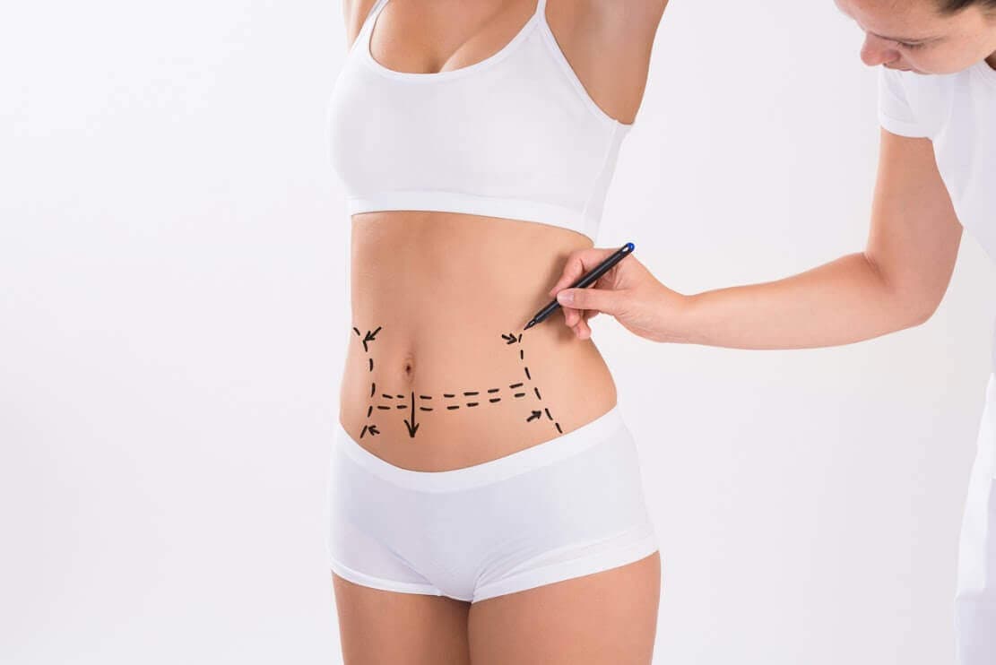 Saiba mais sobre abdominoplastia e tire suas dúvidas