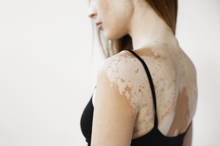 micropigmentação para pacientes com vitiligo