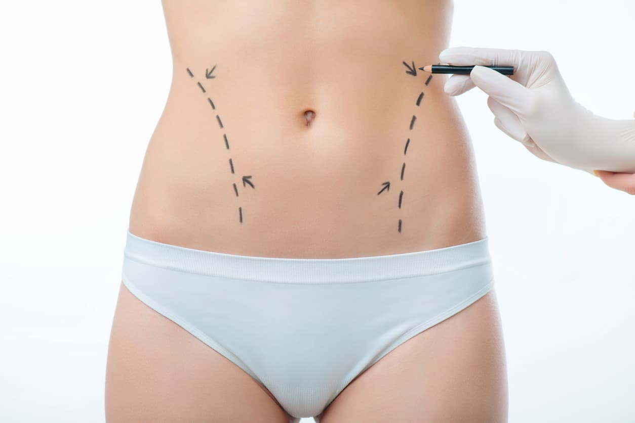 resultados abdominoplastia a longo prazo